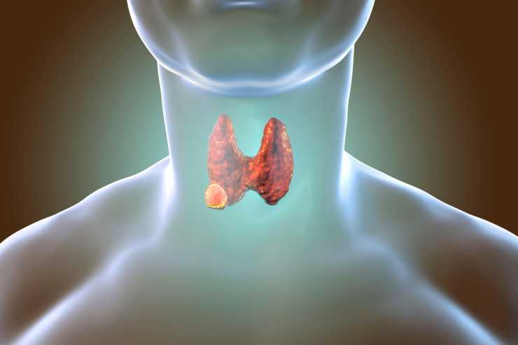 Parathyroid Disorders